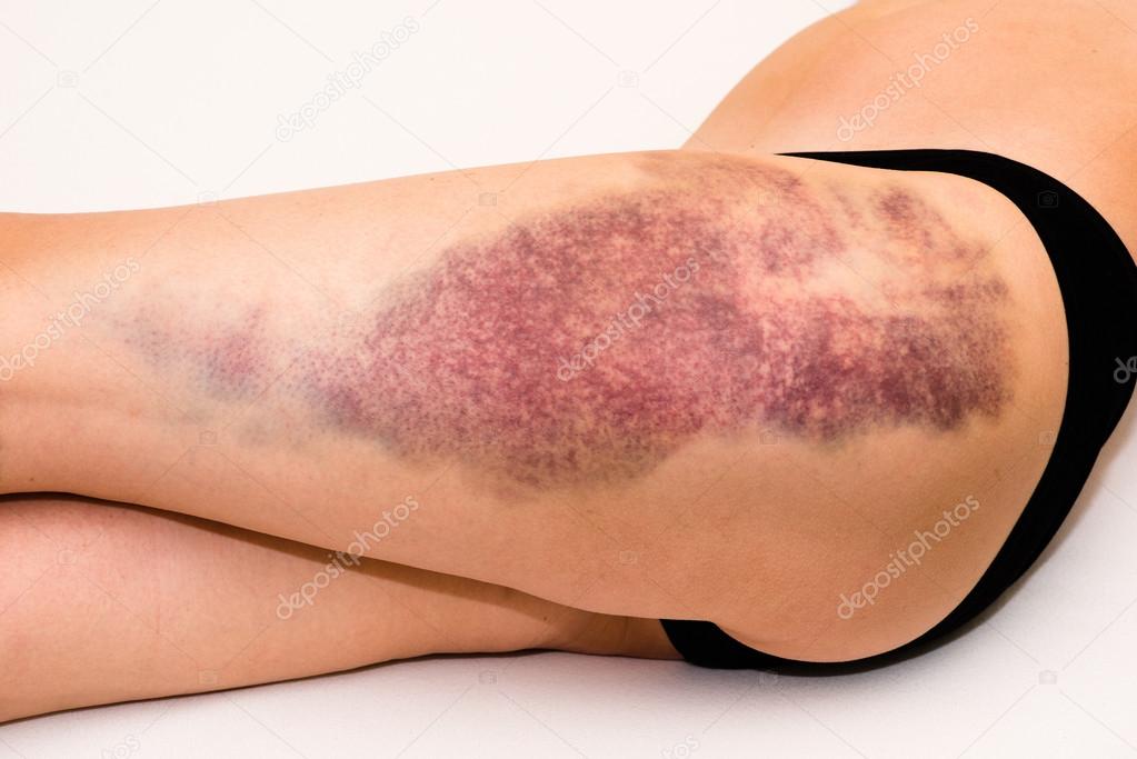 Bruise on wounded woman leg