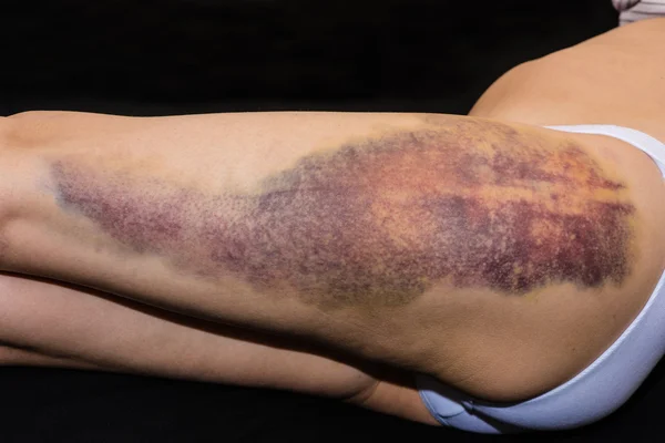 Bruise on wounded woman leg — Stock Photo, Image