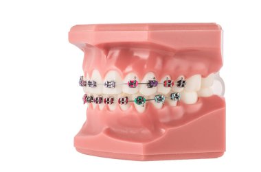 Diş Hekimi Ortodonti Modeli Parantez Gösterimi, Kablo ve Çalışma Hizalaması