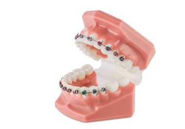 Diş Hekimi Ortodonti Modeli Parantez Gösterimi, Kablo ve Çalışma Hizalaması