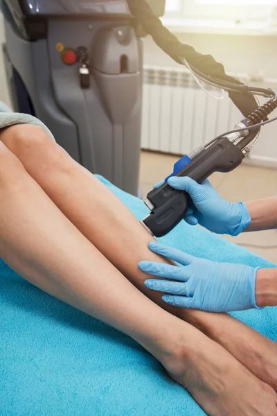 Epilazione delle gambe laser — Foto Stock