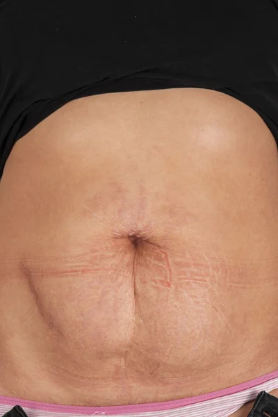 有伸展痕迹的女性腹部 — 图库照片