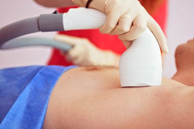 erkek lazer epilasyon