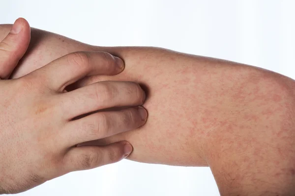 Kratzende Hand mit allergischem Ausschlag — Stockfoto