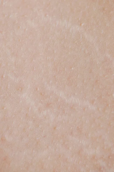 Stretch Human Skin Background Macro Close View — Stock Photo, Image