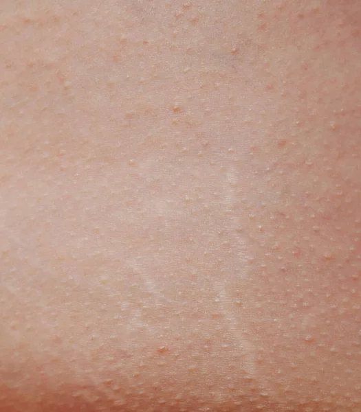 Linjer Från Sträckor Mänsklig Hud Textur Äkta Kvinnlig Hud — Stockfoto