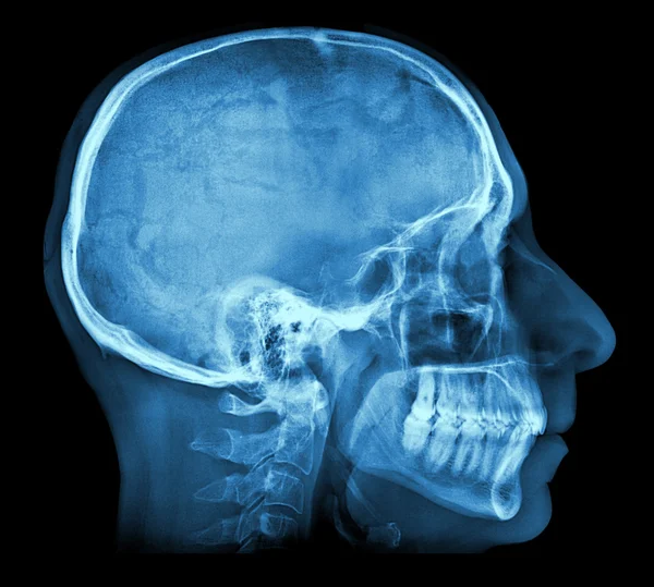 İnsan kafatası X-ray görüntü — Stok fotoğraf