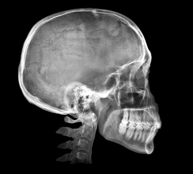 İnsan kafatası X-ray görüntü