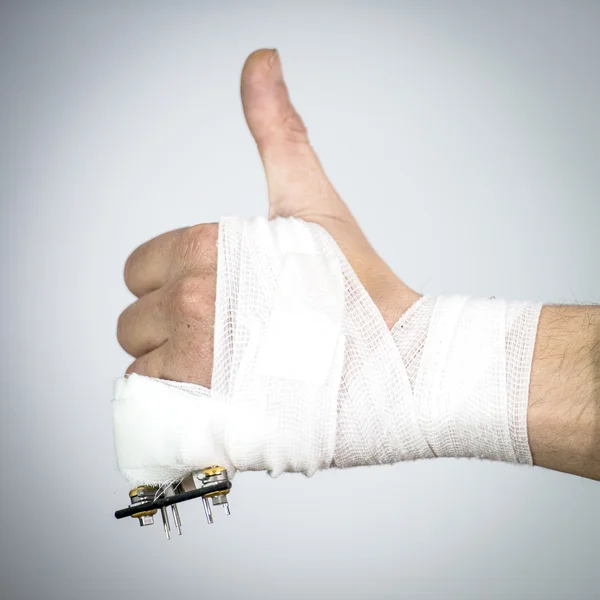 Hand with a broken pinky finger — Stock Photo, Image