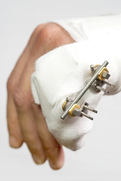 Externe Bohrinsel, um eine gebrochene Hand zu reparieren — Stockfoto