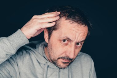 Şakaklarda saç dökülmesi, aynada alnına bakan bir adam.