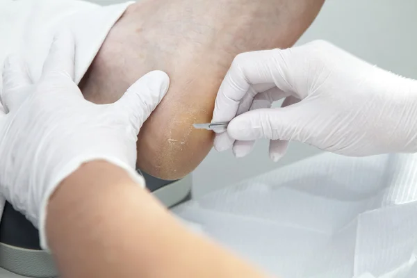 Removing dry callus of feet — Stock Photo, Image