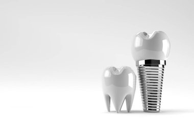 Diş implantı cerrahi konsepti 3 boyutlu oluşturma.