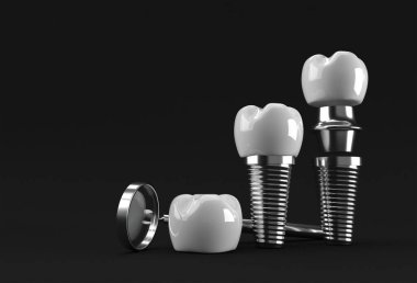Diş implantı cerrahi konsepti 3 boyutlu oluşturma.