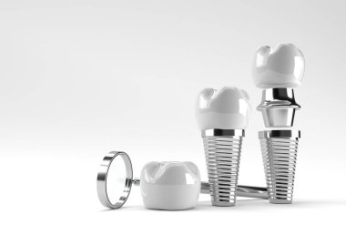 Diş implantı cerrahi konsepti 3 boyutlu oluşturma.