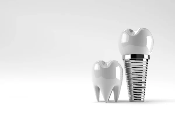 Koncepcja Operacji Implantów Dentystycznych Rendering — Zdjęcie stockowe