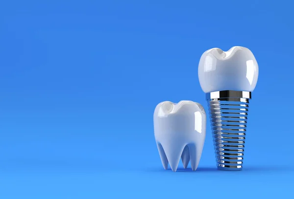 Koncepcja Operacji Implantów Dentystycznych Rendering — Zdjęcie stockowe