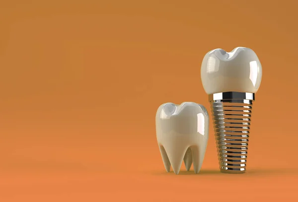 Koncepcja Operacji Implantów Dentystycznych Rendering — Zdjęcie stockowe