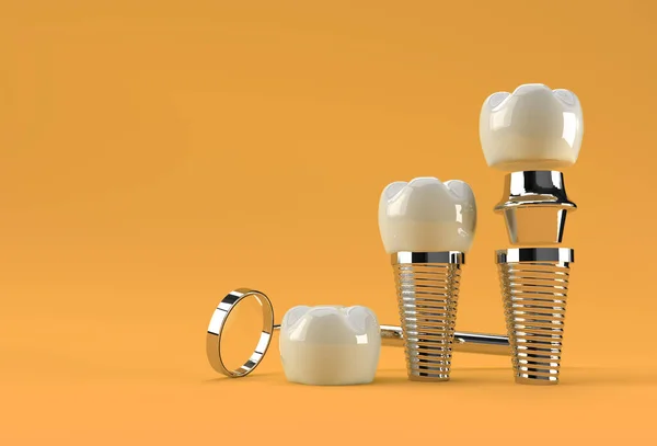 Koncepcja Operacji Implantów Dentystycznych Rendering — Zdjęcie stockowe