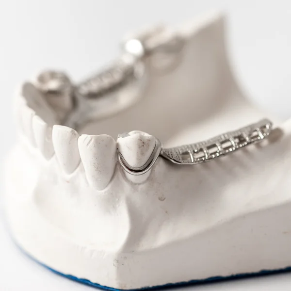 Nižší Částečná zubní protéza s přílohami — Stock fotografie