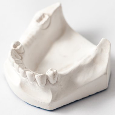 Ekleri olan alt kısmi takma diş 