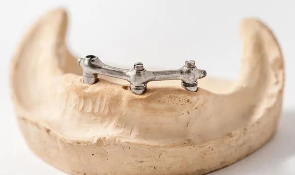 Slipat bar med tre implantat — Stockfoto