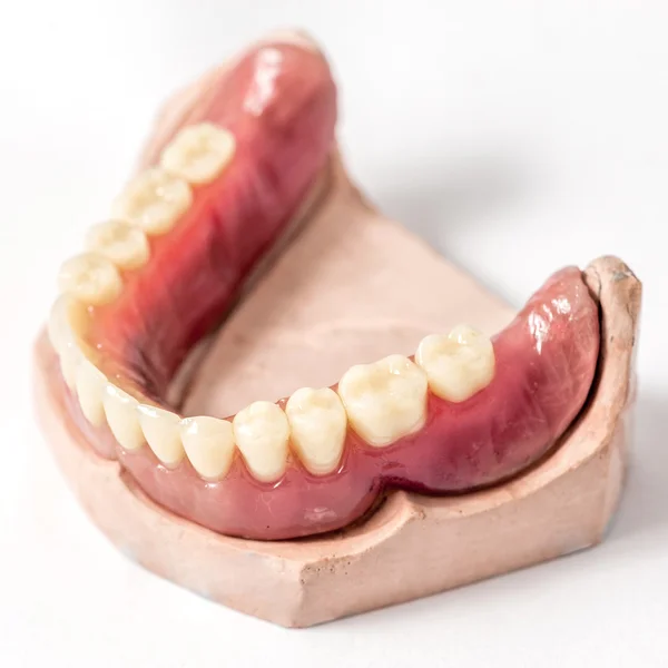 Prótesis dentaria inmediata Superior —  Fotos de Stock