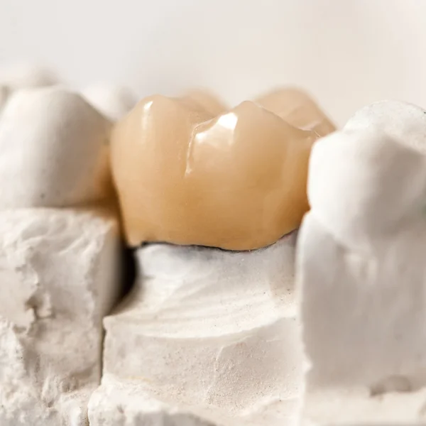 Tlenku cyrkonu korony zęba trzonowego — Zdjęcie stockowe