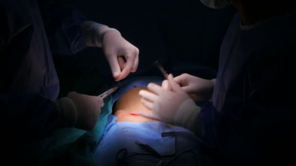 Операція хірургії в лікарні — стокове відео