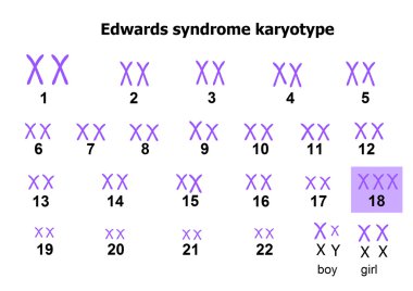 Edwards syndrome karyotype clipart