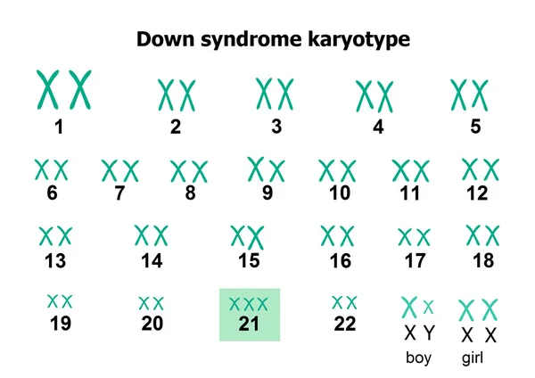 Downs syndrom Karyotyp — Stock vektor