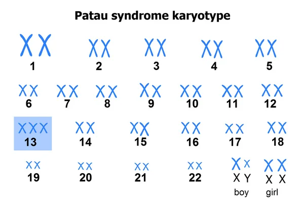 Cariotipo síndrome de Patau — Vector de stock