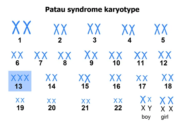 Síndrome de Patau cariótipo —  Vetores de Stock