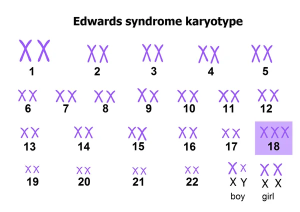 Cariotipo síndrome de Edwards — Archivo Imágenes Vectoriales