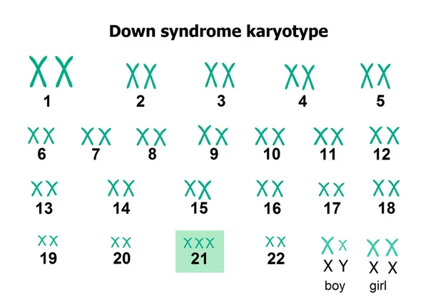 Sindrome di Down cariotipo — Vettoriale Stock