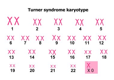 Turner Sendromu karyotip