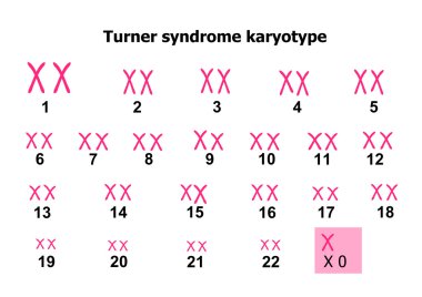 Turner syndrome karyotype clipart