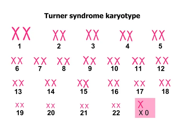 Cariotipo síndrome de Turner — Archivo Imágenes Vectoriales