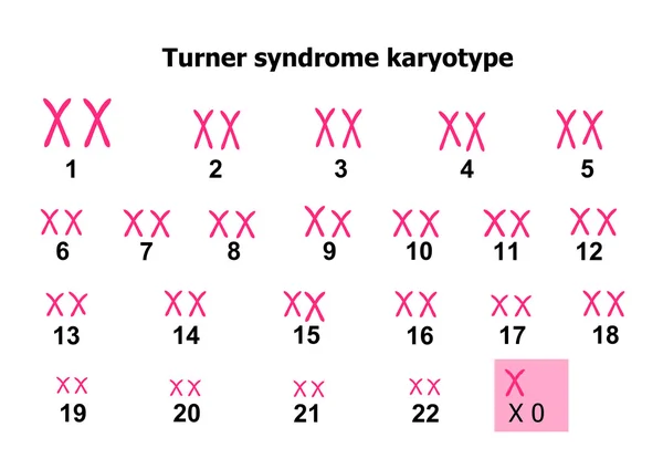 Turner syndroom karyotype — Stockvector
