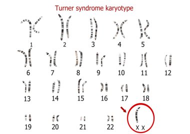 Turner Sendromu karyotip