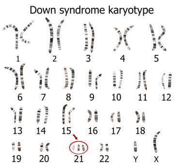 Down syndrome karyotype clipart