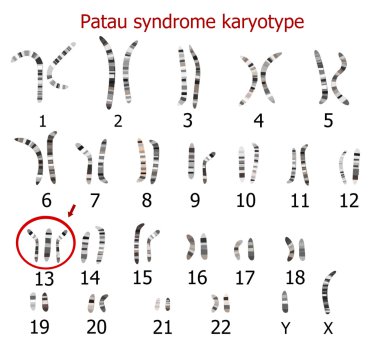 Patau syndrome karyotype clipart