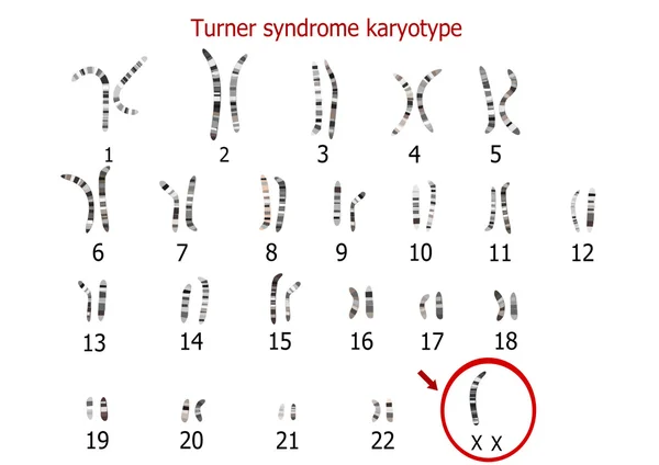 Sindrome di Turner cariotipo — Vettoriale Stock