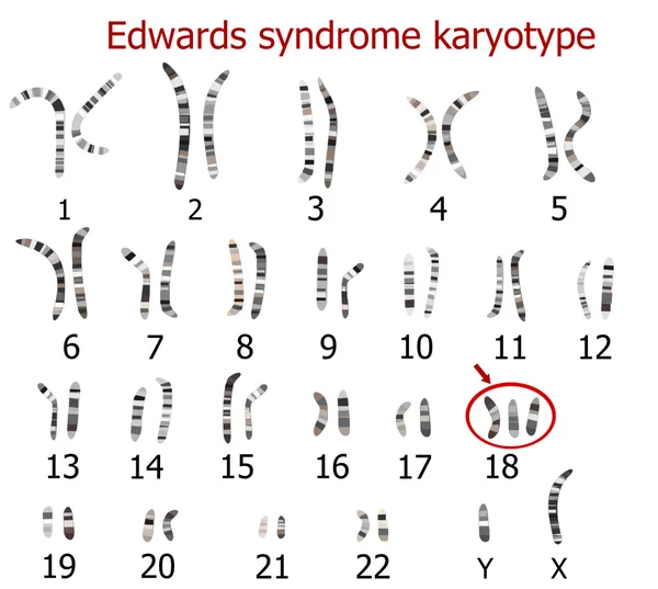 Cariotipo síndrome de Edwards — Archivo Imágenes Vectoriales