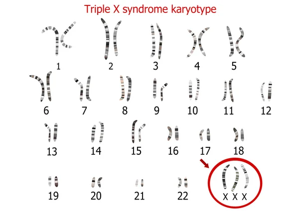 Triple X oireyhtymä karyotyyppi — vektorikuva
