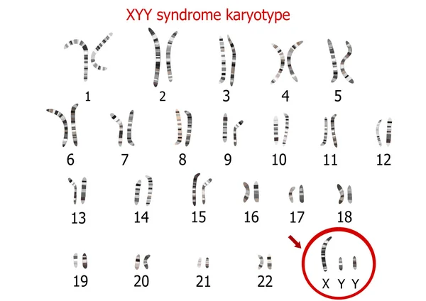 Cariotipo del síndrome XYY (supermasculino) — Archivo Imágenes Vectoriales