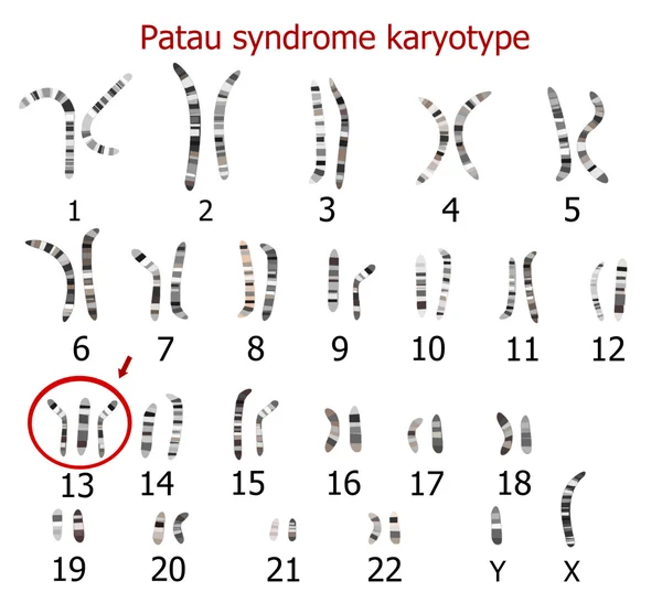 パトー症候群染色体核型 — ストックベクタ