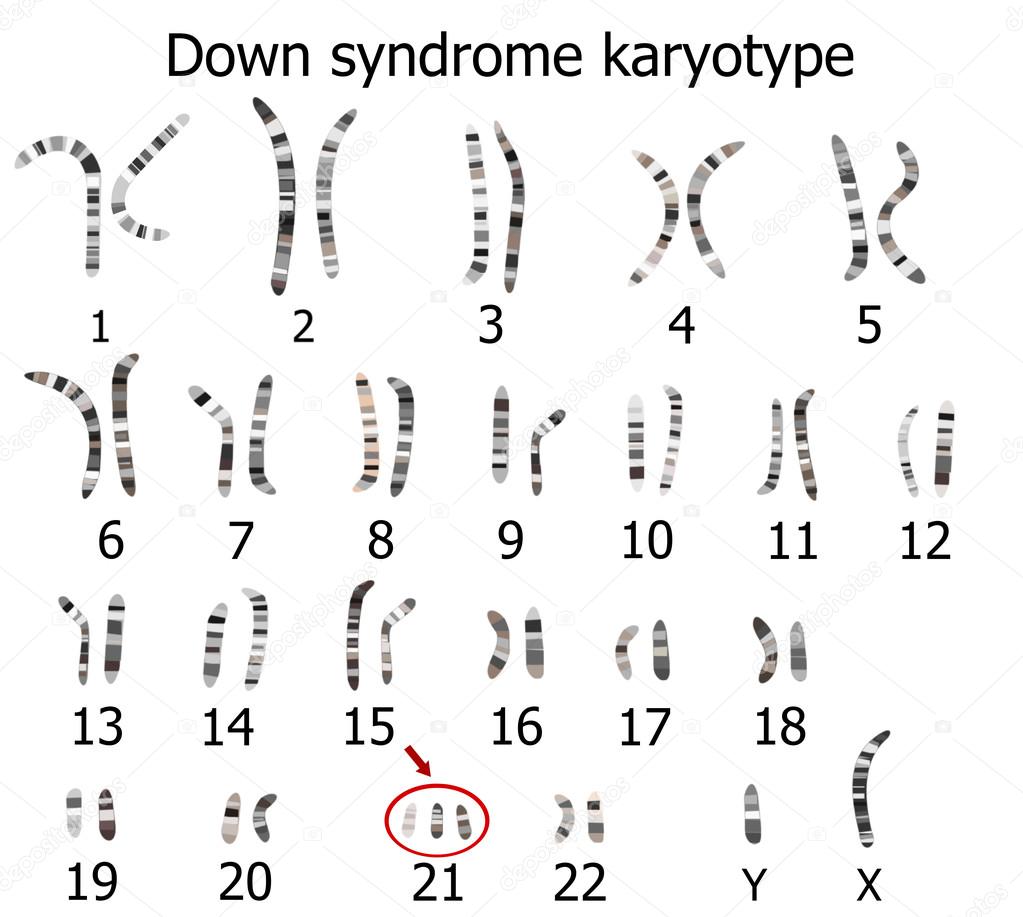 Down syndrome karyotype — Stock Vector © zuzanaa #68702137