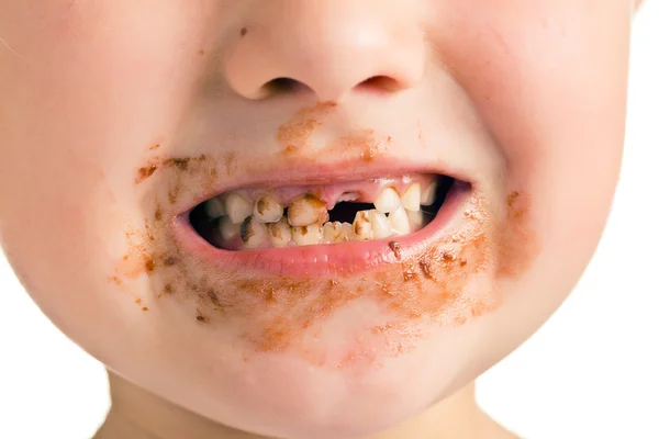 child with a dirty mouth and missing tooth