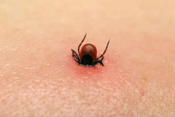 Encefalitis garrapata — Foto de Stock